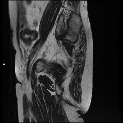 File:Bilateral ovarian fibroma (Radiopaedia 44568-48293 Sagittal T2 29).jpg