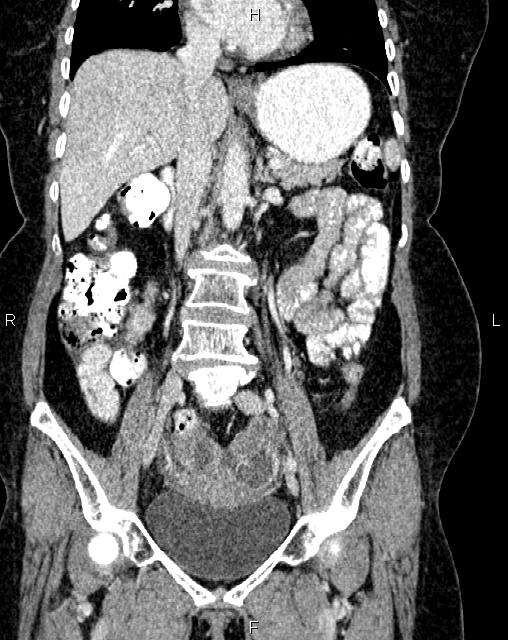 Bilateral ovarian serous cystadenocarcinoma (Radiopaedia 86062-101989 D 22).jpg