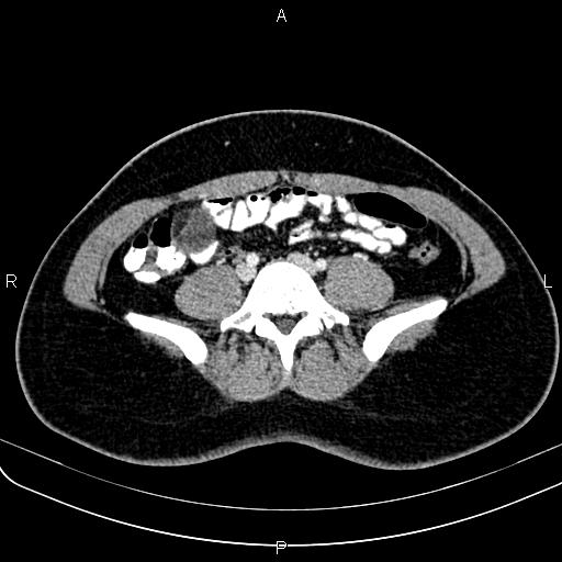 Bilateral ovarian teratoma (Radiopaedia 83131-97503 Axial With contrast 6).jpg