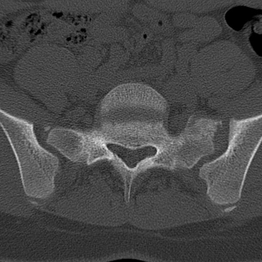 File:Bilateral pars defect (Radiopaedia 26691-26846 Axial bone window 73).jpg