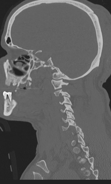 Bilateral perched facet joint (Radiopaedia 63149-71669 Sagittal bone window 3).jpg