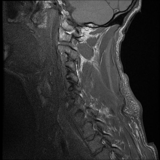 File:Bilateral perched facets with cord injury (Radiopaedia 45587-49714 Sagittal T1 3).jpg
