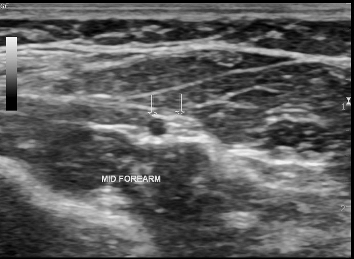 File:Bilateral persistent median artery of the forearm with unilateral bifid median nerve (Radiopaedia 17430-17120 E 1).jpg