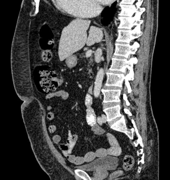 Bilateral rectus sheath hematomas (Radiopaedia 50778-56252 B 39).jpg