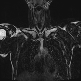 File:Bilateral spinoglenoid notch ganglion cysts (Radiopaedia 29577-30082 Coronal T2 33).jpg