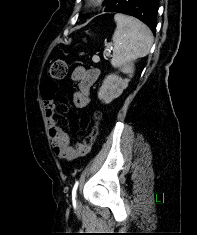 Bilateral sporadic synchronous clear cell renal cell carcinoma (Radiopaedia 85035-100575 E 36).jpg