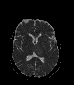 File:Bilateral thalamic glioma (Radiopaedia 65852-75009 Axial ADC 12).jpg