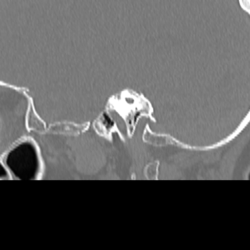 File:Bilateral tympanoplasty (Radiopaedia 16947-16664 Sagittal bone window 52).jpg