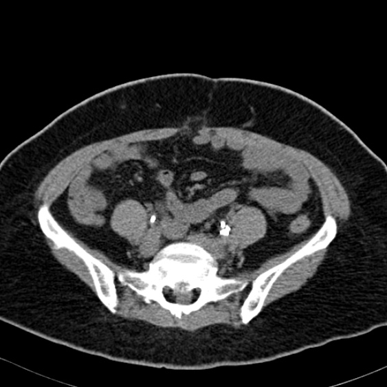 Bilateral ureteric stents (Radiopaedia 48795-53825 Axial non-contrast 43).jpg
