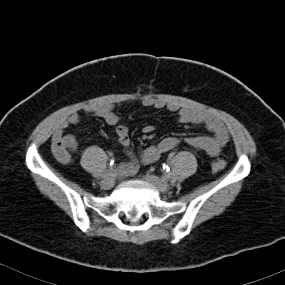 File:Bilateral ureteric stents (Radiopaedia 48795-53825 Axial non-contrast 44).jpg