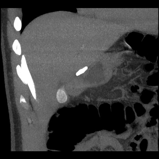File:Bile leak from liver traumatic laceration (Radiopaedia 63463-72077 Coronal Biliscopin 11).jpg