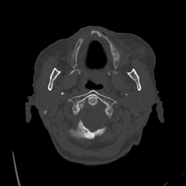 Biparietal osteodystrophy (Radiopaedia 46109-50463 bone window 6).jpg