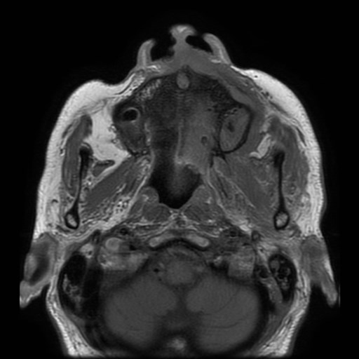 Bisphosphonate-related osteonecrosis of the maxilla (Radiopaedia 51367-57101 Axial T1 26).jpg