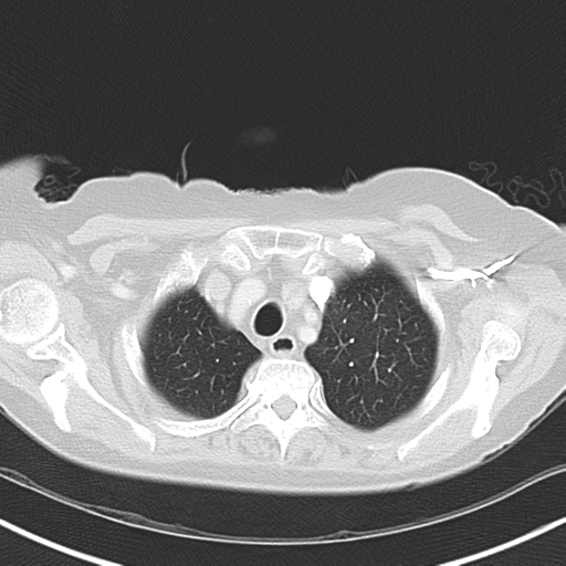 File:Bladder and bowel cancers (Radiopaedia 37688-39592 Axial lung window 9).png