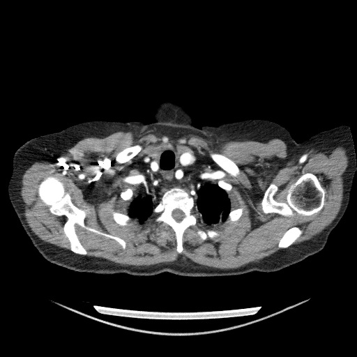 File:Bladder tumor detected on trauma CT (Radiopaedia 51809-57609 A 13).jpg