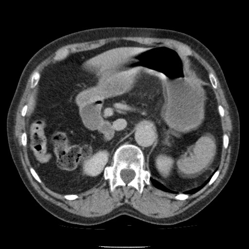 Bladder tumor detected on trauma CT (Radiopaedia 51809-57609 C 39).jpg