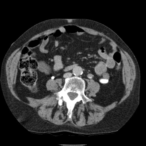 Bladder tumor detected on trauma CT (Radiopaedia 51809-57609 C 80).jpg