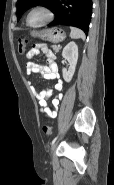 Bleeding duodenal ulcer and adenomyomatosis of gallbladder (Radiopaedia 61834-69861 C 70).jpg
