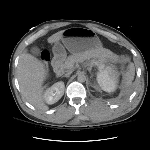 Blunt abdominal trauma with solid organ and musculoskelatal injury with active extravasation (Radiopaedia 68364-77895 Axial C+ delayed 41).jpg