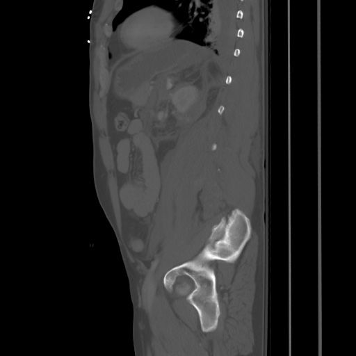 Blunt abdominal trauma with solid organ and musculoskelatal injury with active extravasation (Radiopaedia 68364-77895 Sagittal bone window 74).jpg