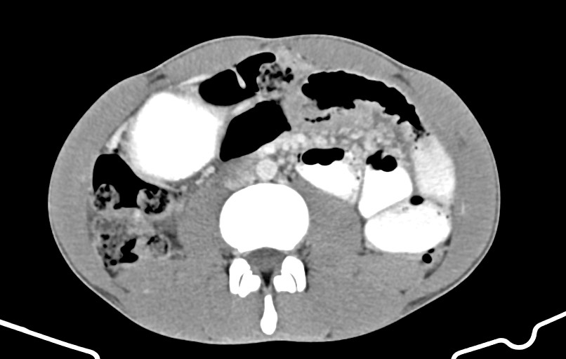 Blunt injury to the small bowel (Radiopaedia 74953-85987 A 93).jpg
