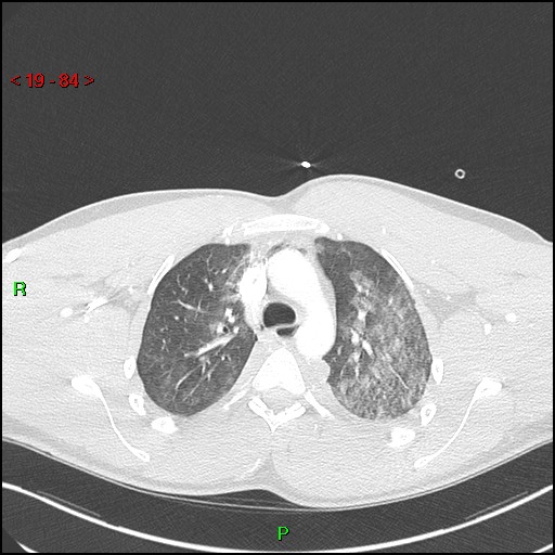 Blunt thoracic trauma (Radiopaedia 73454-84221 Axial lung window 31).jpg