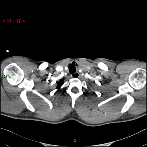 Blunt thoracic trauma (Radiopaedia 73454-84221 Axial soft tissues 7).jpg