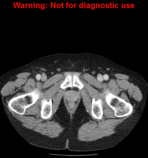 File:Bosniak renal cyst - type IV (Radiopaedia 23402-23466 D 83).jpg
