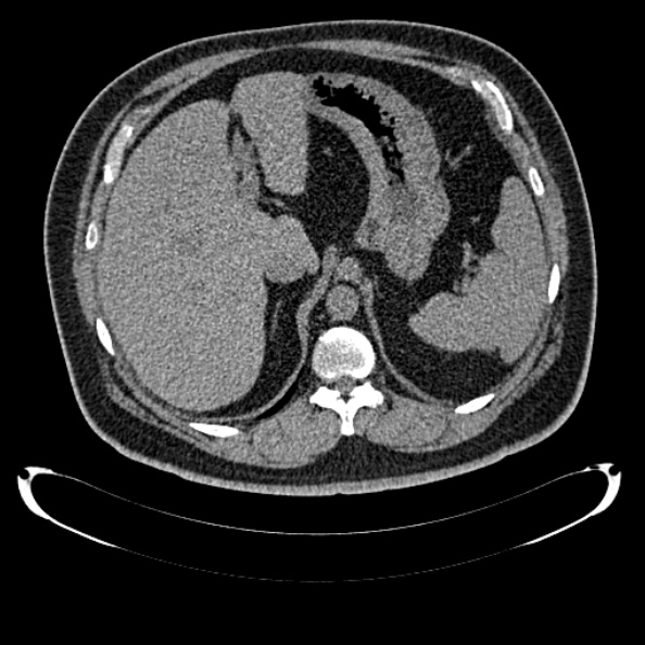 Bosniak renal cyst - type IV (Radiopaedia 24244-24518 Axial non-contrast 97).jpg