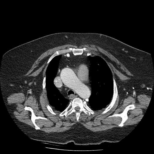 Bovine aortic arch - right internal mammary vein drains into the superior vena cava (Radiopaedia 63296-71875 A 38).jpg