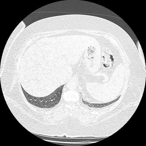 Bovine aortic arch - right internal mammary vein drains into the superior vena cava (Radiopaedia 63296-71875 Axial lung window 164).jpg