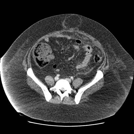File:Bowel and splenic infarcts in acute lymphocytic leukemia (Radiopaedia 61055-68915 A 94).jpg