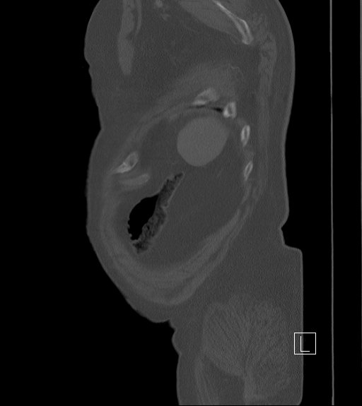 Bowel ischemia secondary to SMA occlusion with extensive portomesenteric venous gas (Radiopaedia 54656-60871 Sagittal bone window 8).jpg