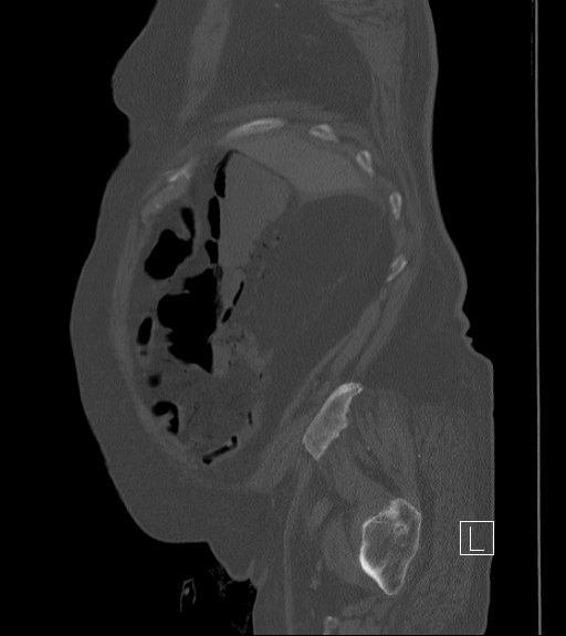 File:Bowel ischemia secondary to SMA occlusion with extensive portomesenteric venous gas (Radiopaedia 54656-60871 Sagittal bone window 98).jpg