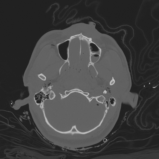 Brain contusions, internal carotid artery dissection and base of skull fracture (Radiopaedia 34089-35339 Axial bone window 45).png