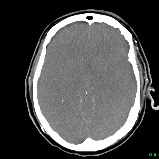 Brain death on MRI and CT angiography (Radiopaedia 42560-45841 B 29).jpg