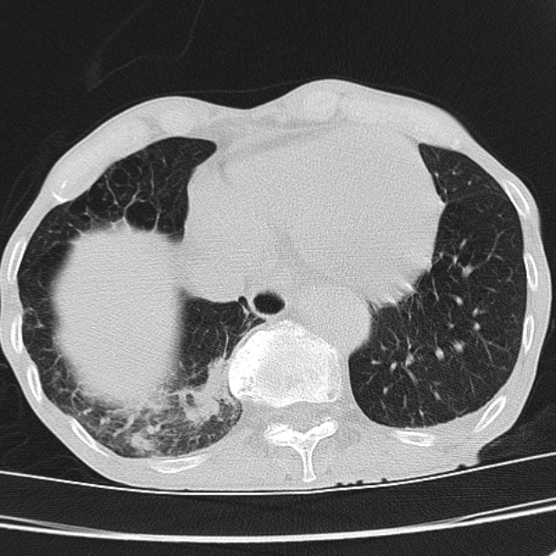 Brain metastases from lung cancer (Radiopaedia 27849-28093 Axial lung window 52).jpg