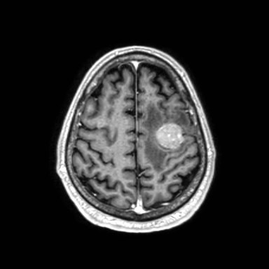 Brain metastases from lung cancer (Radiopaedia 83839-99028 Axial T1 C+ 54).jpg