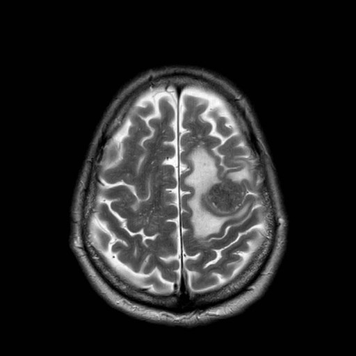 File:Brain metastases from lung cancer (Radiopaedia 83839-99028 Axial T2 29).jpg