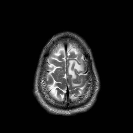 File:Brain metastases from lung cancer (Radiopaedia 83839-99028 Axial T2 32).jpg