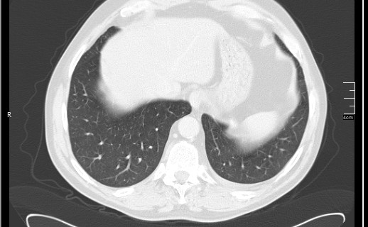 Brain metastases from squamocellular lung cancer (Radiopaedia 56515-63219 Axial lung window 53).jpg