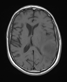 File:Brain metastasis (large cystic mass) (Radiopaedia 47497-52107 Axial T1 16).png
