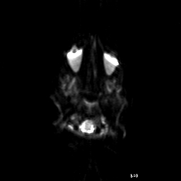 File:Brainstem ganglioglioma (Radiopaedia 10763-11224 Axial DWI 17).jpg