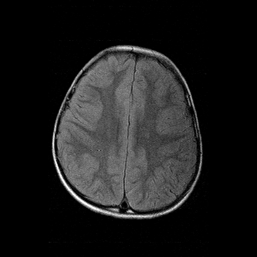 File:Brainstem ganglioglioma (Radiopaedia 10763-11224 Axial FLAIR 6).jpg