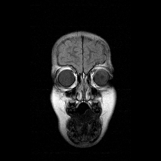 File:Brainstem ganglioglioma (Radiopaedia 10763-11224 Coronal FLAIR 18).jpg