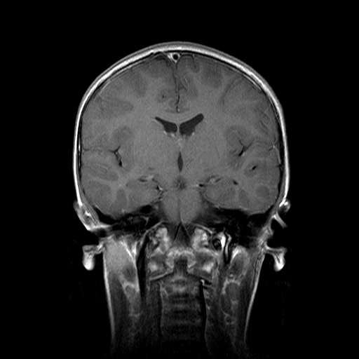 File:Brainstem ganglioglioma (Radiopaedia 10763-11224 Coronal T1 C+ 10).jpg