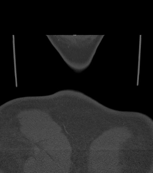 Branchial cleft cyst (Radiopaedia 31167-31875 Coronal bone window 66).jpg