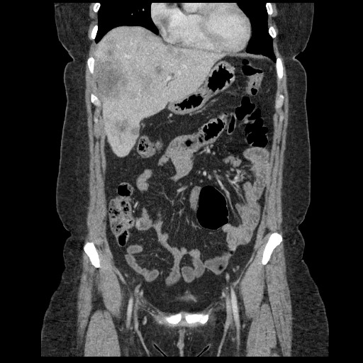 File:Breast cancer pseudocirrhosis after chemotherapy (Radiopaedia 65407-74456 B 30).jpg