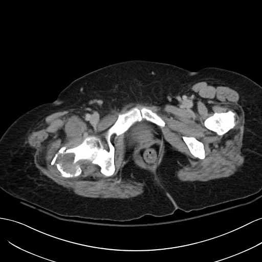 Breast carcinoma with pathological hip fracture (Radiopaedia 60314-67974 B 73).jpg