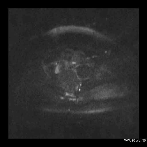 File:Broad ligament fibroid (Radiopaedia 49135-54241 Axial DWI 20).jpg